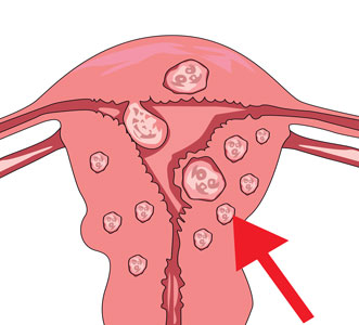 Fibromes