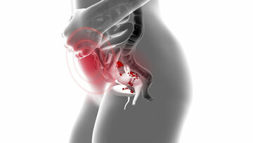 Endométriose Endométriose